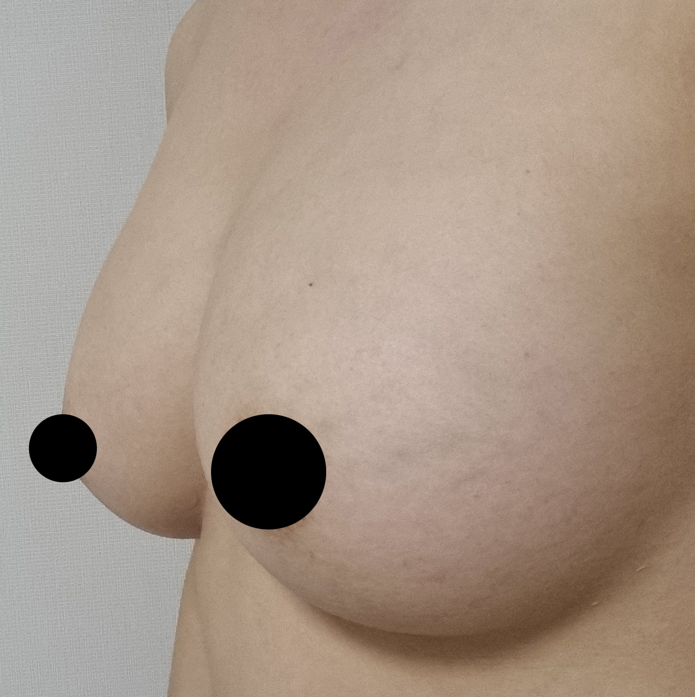 수술후기이미지