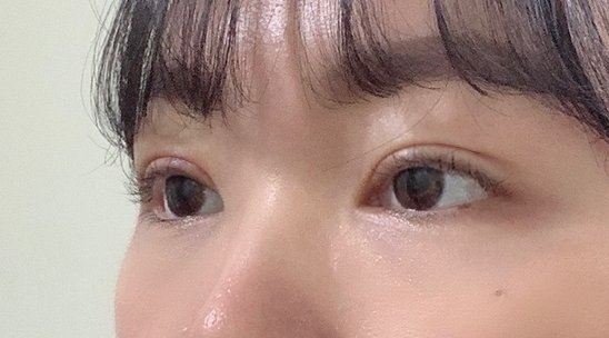 수술후기이미지