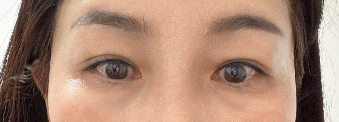 수술후기이미지