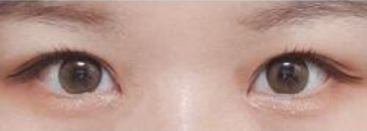 쌍수후기입니당