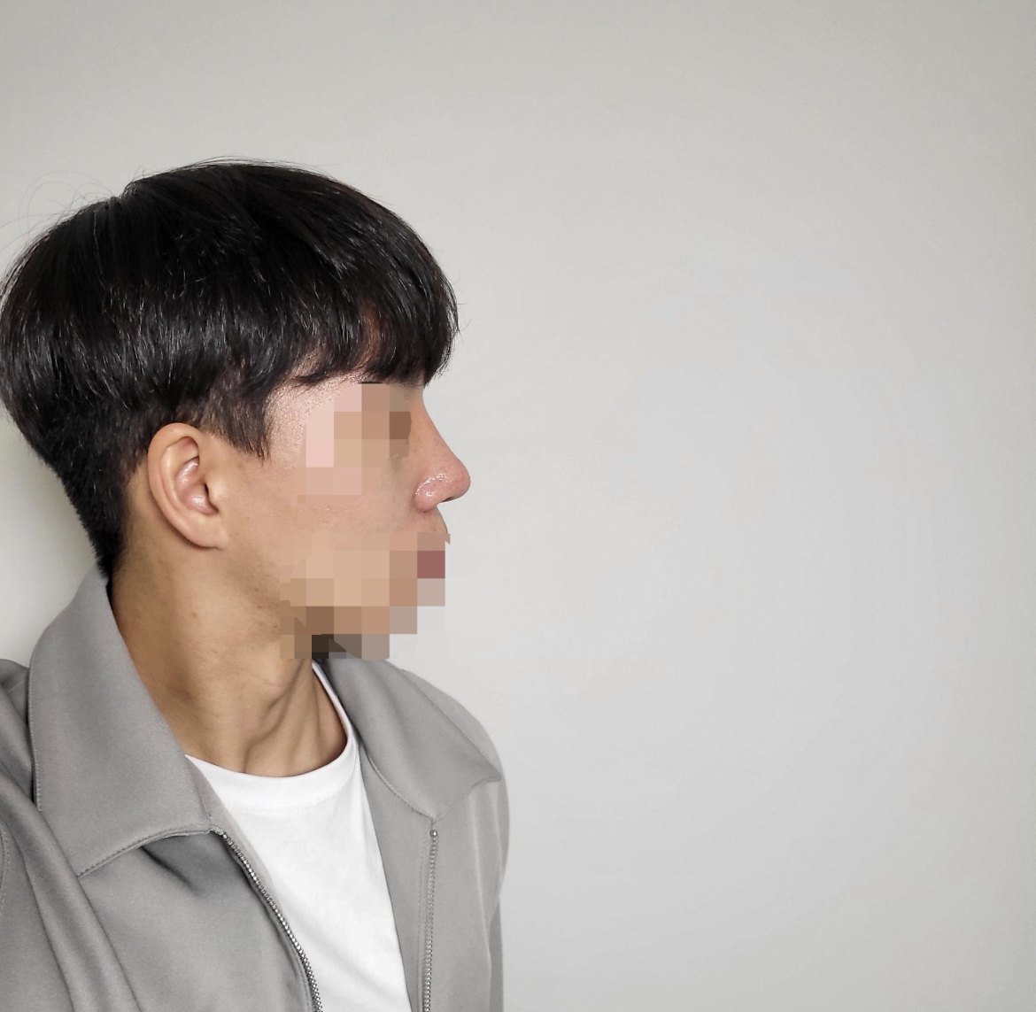 수술후기이미지