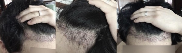 모발이식 후기입니다