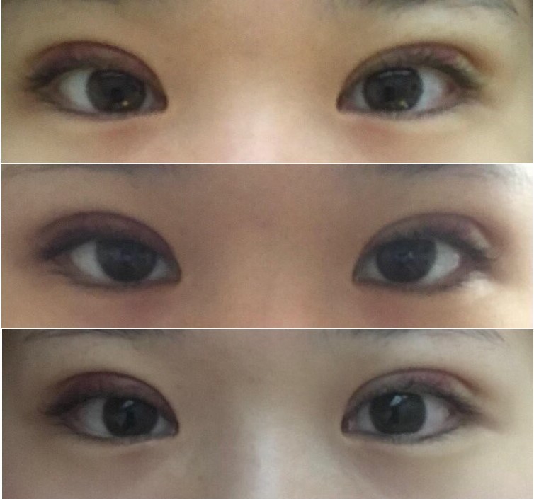 수술후기이미지