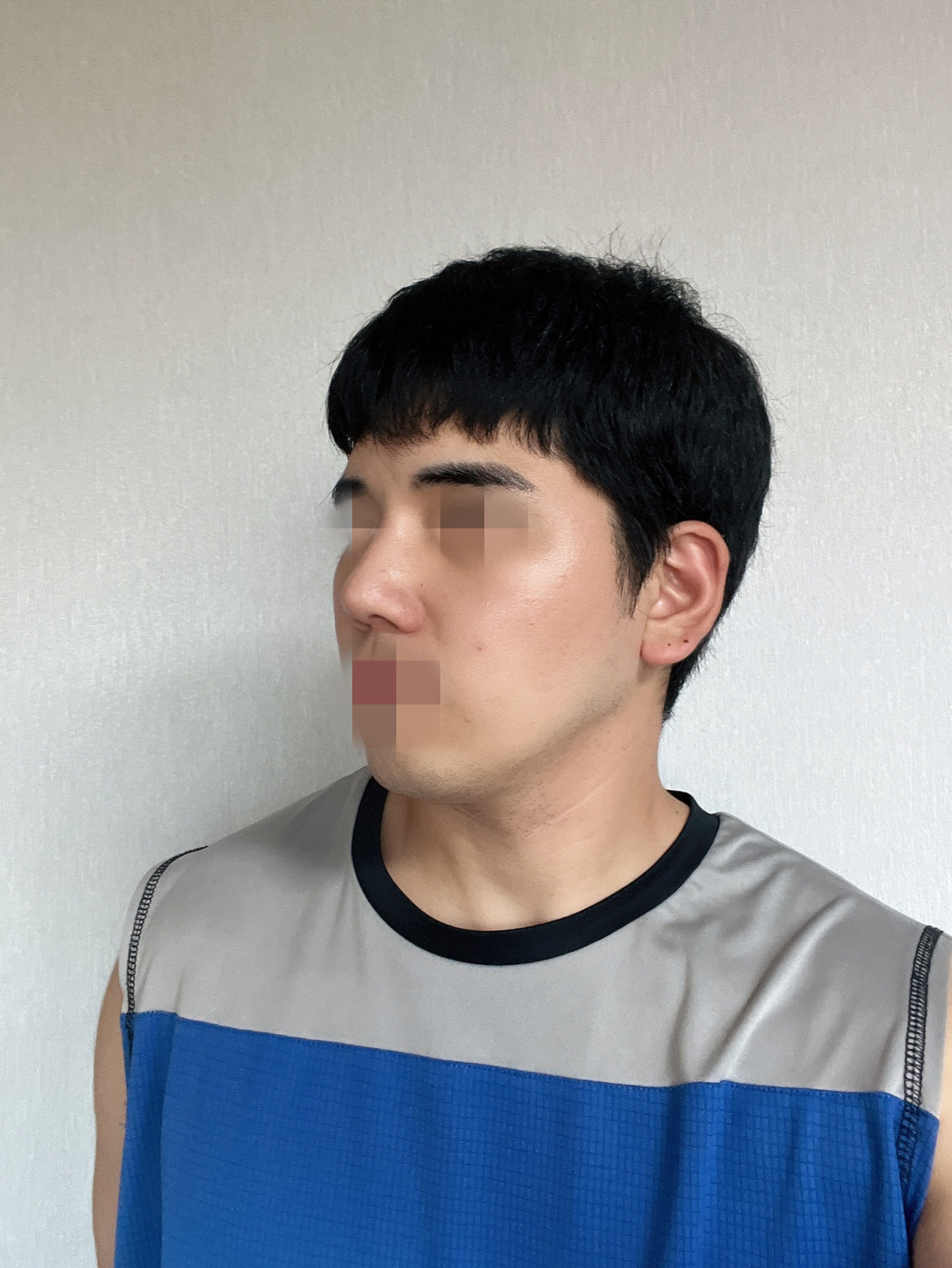 수술후기이미지