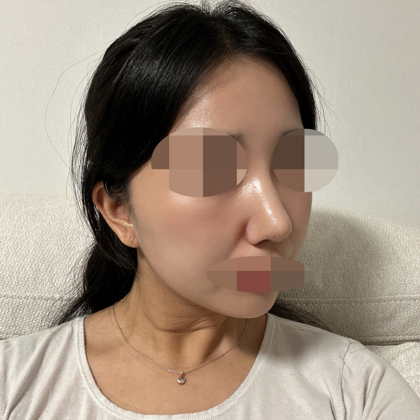 수술후기이미지