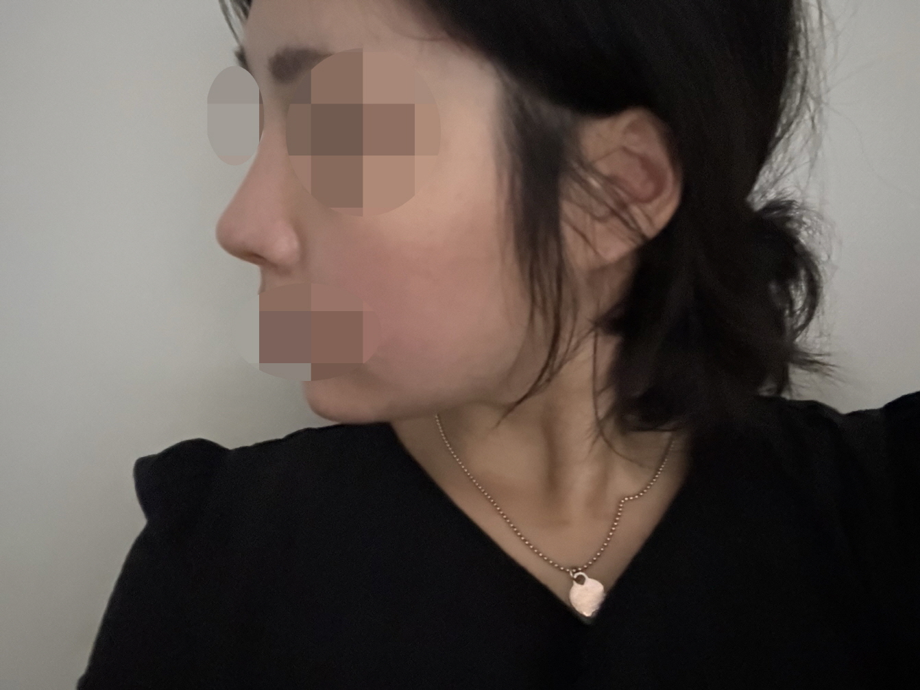 수술후기이미지