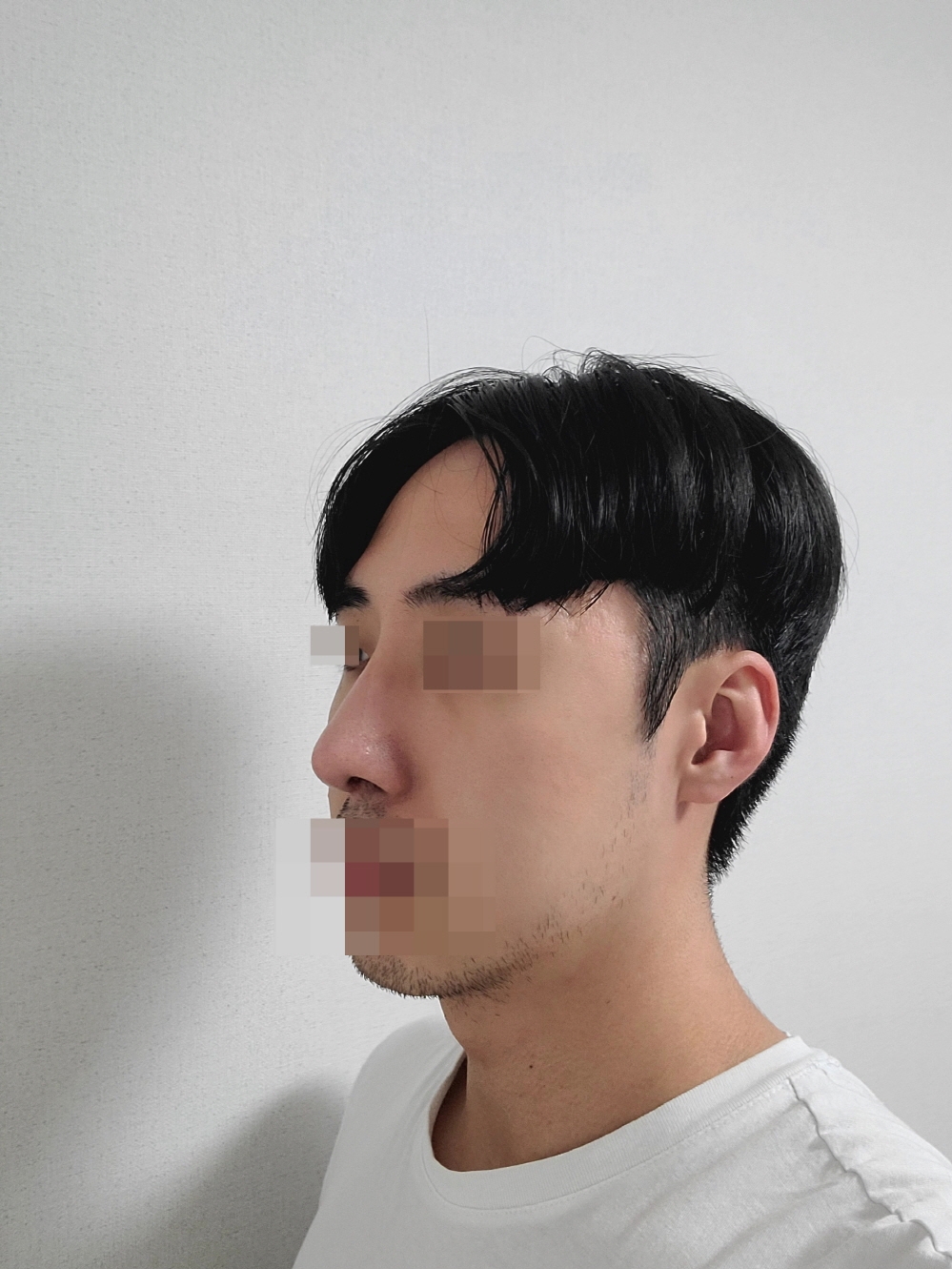 수술후기이미지