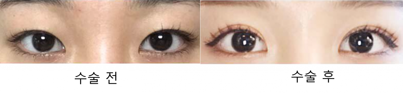 수술후기이미지