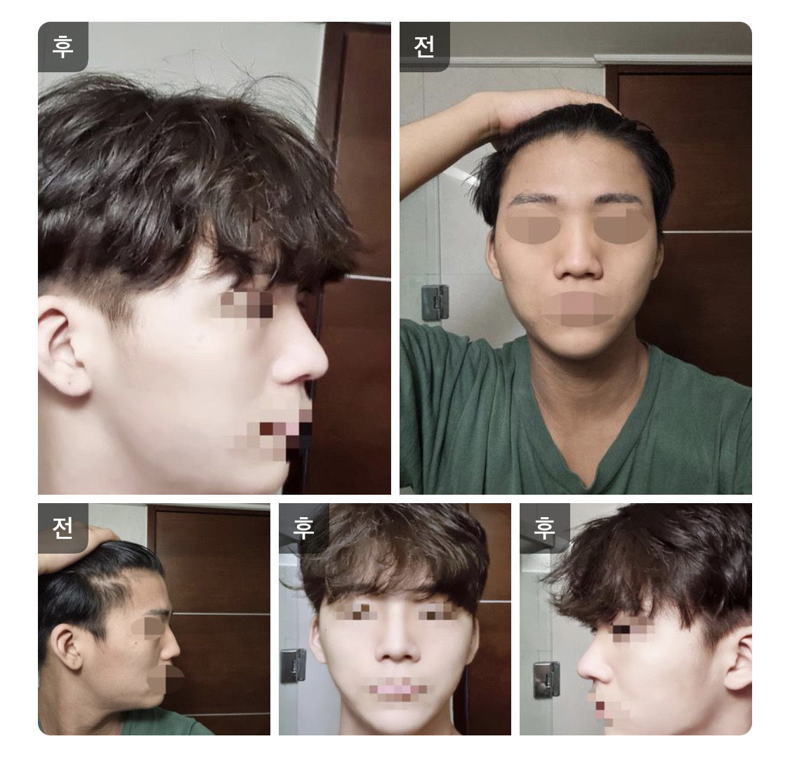 수술후기이미지