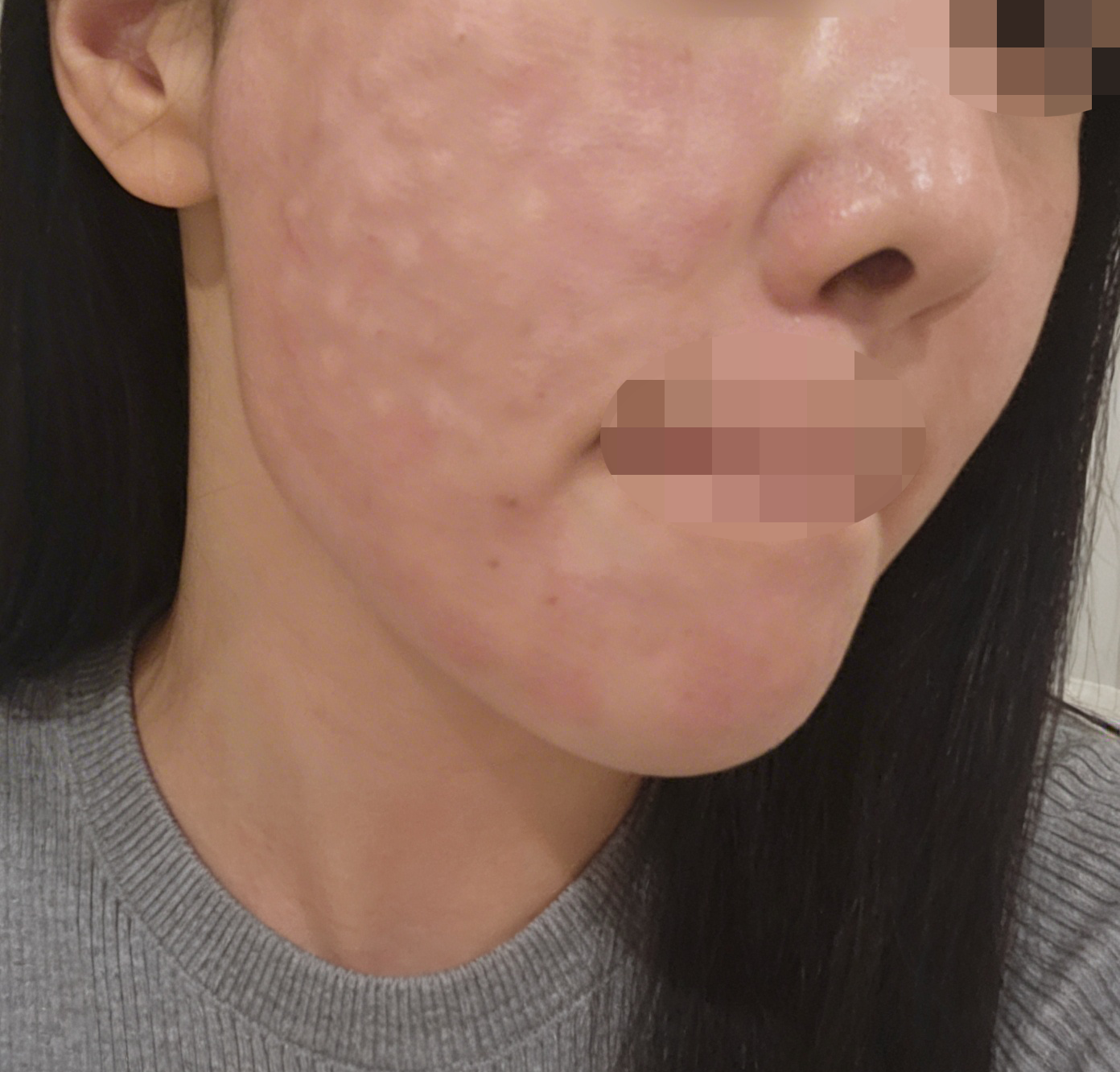 수술후기이미지