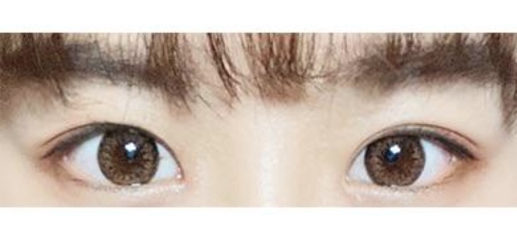 수술후기이미지