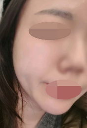 수술후기이미지