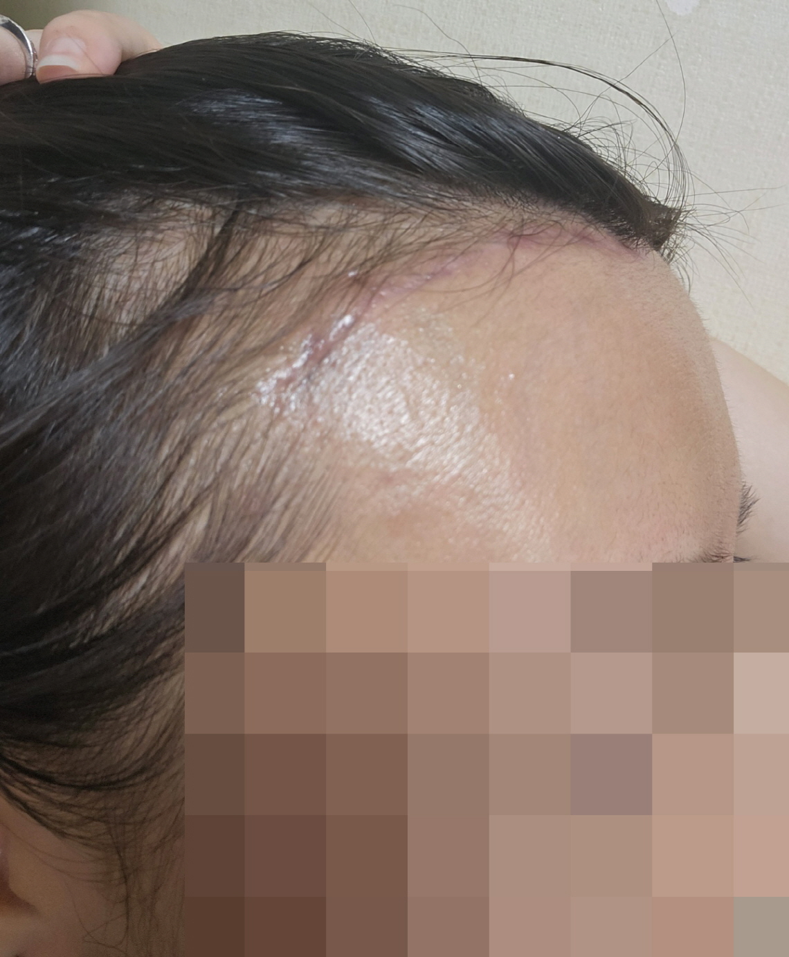 수술후기이미지