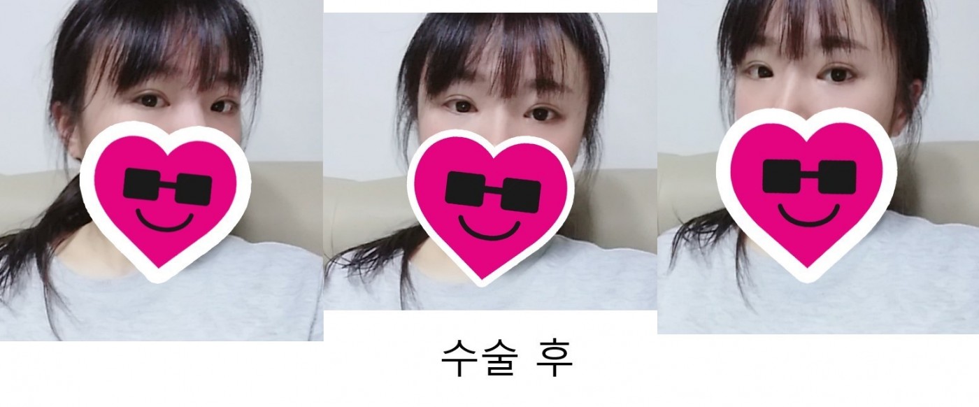 수술후기이미지