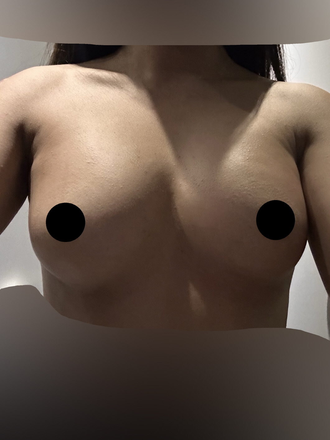 수술후기이미지