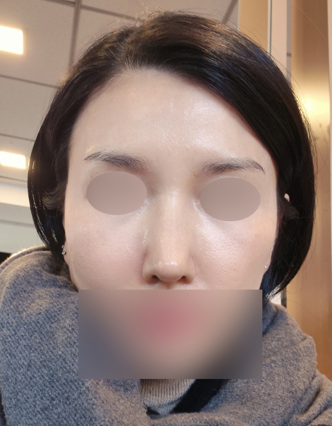 수술후기이미지