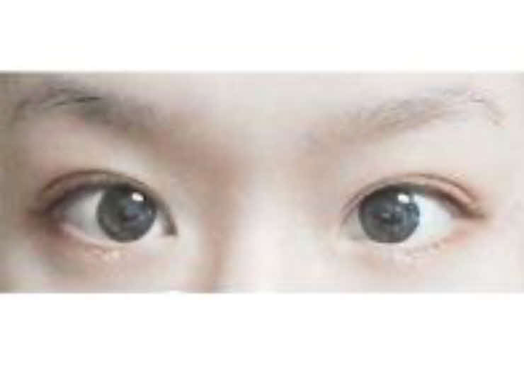 눈매교정 쌍수~~