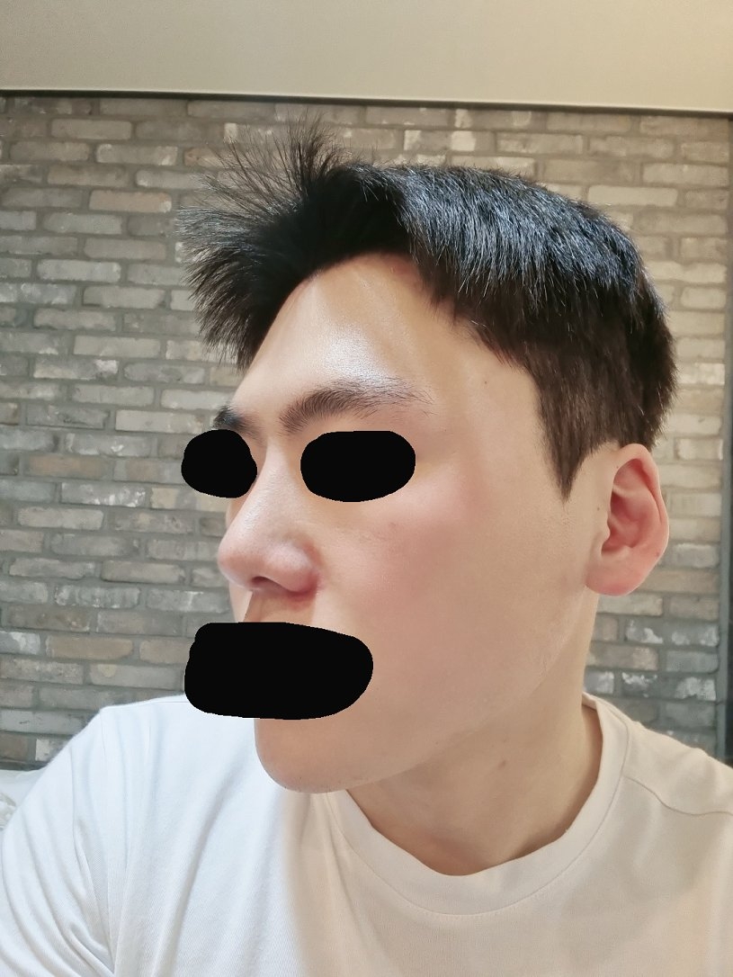 수술후기이미지