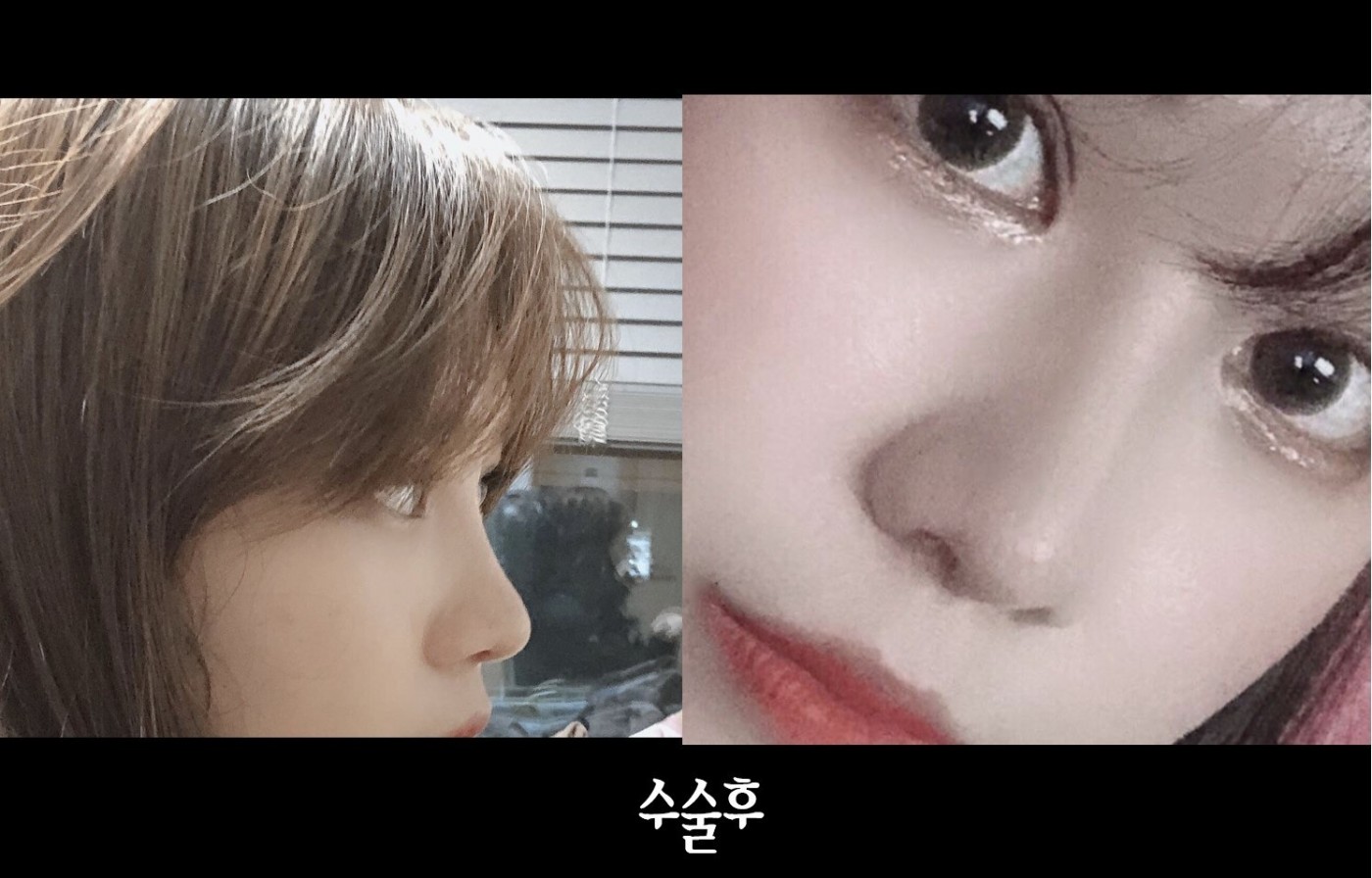 수술후기이미지