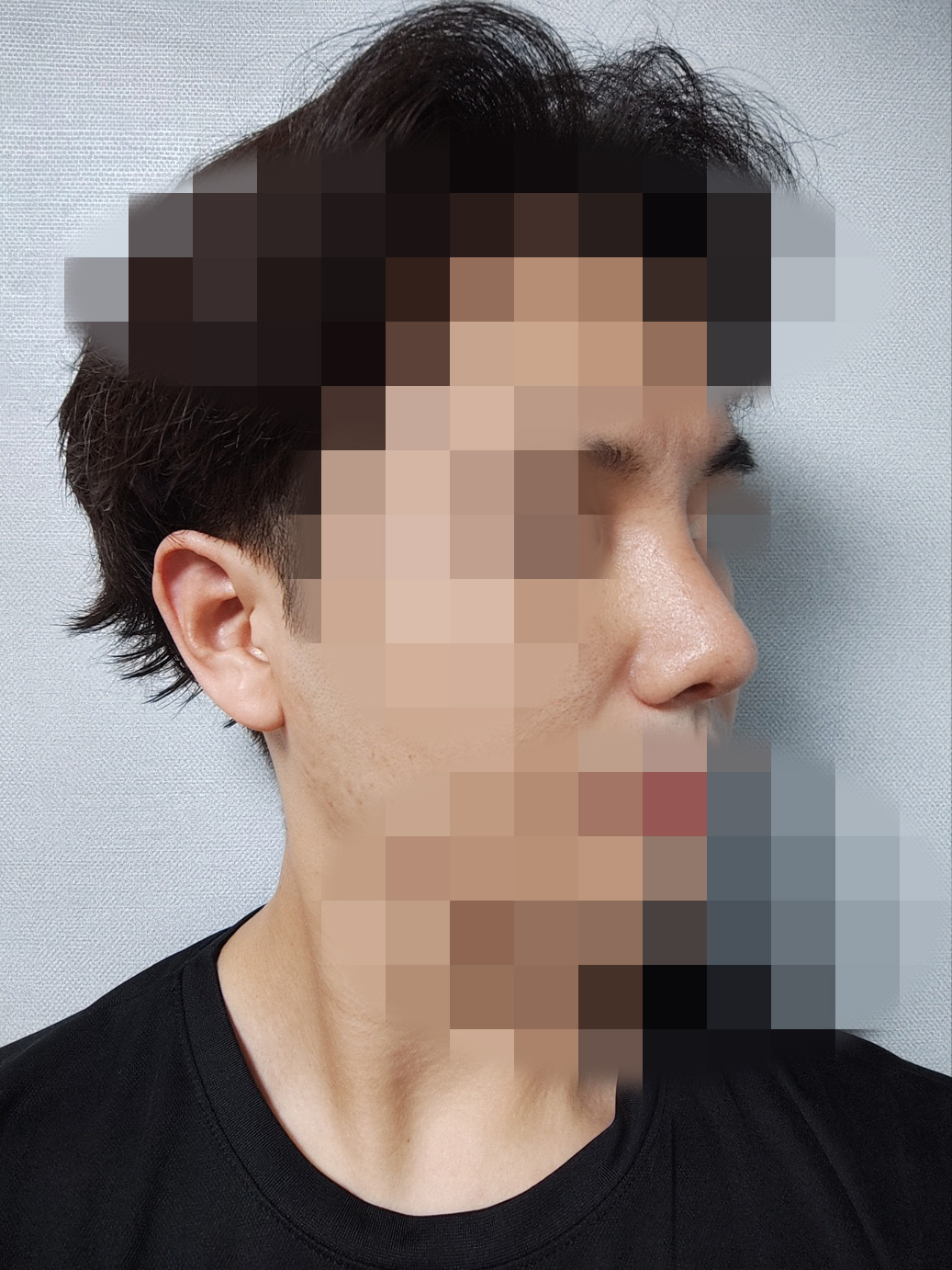 수술후기이미지