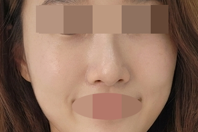 수술후기이미지