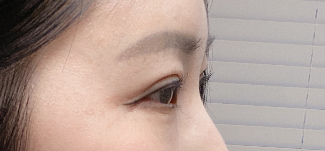 수술후기이미지