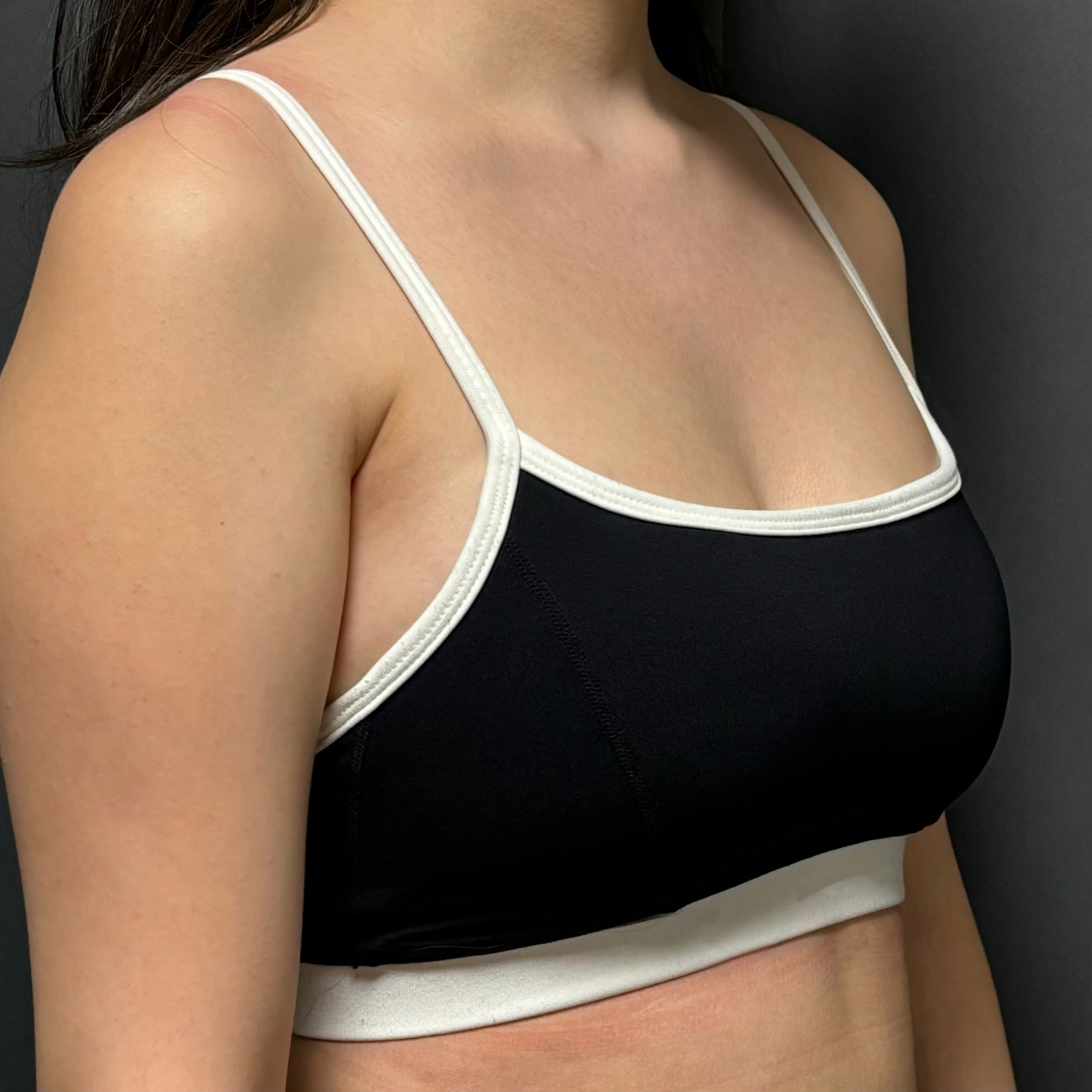 수술후기이미지