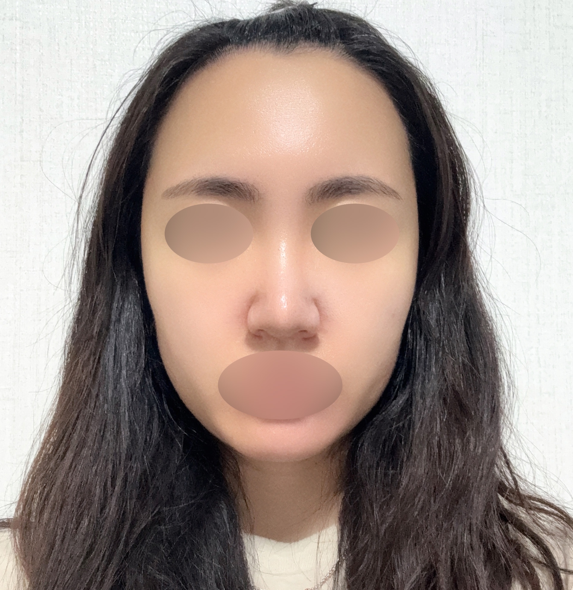 수술후기이미지