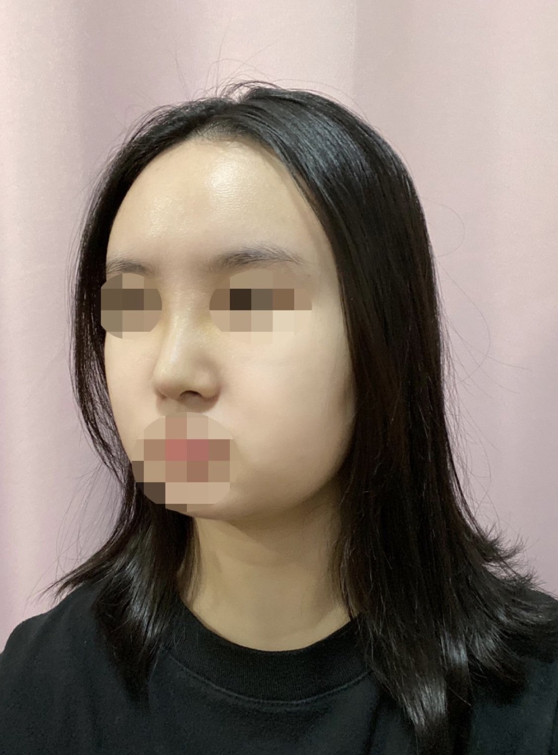 수술후기이미지