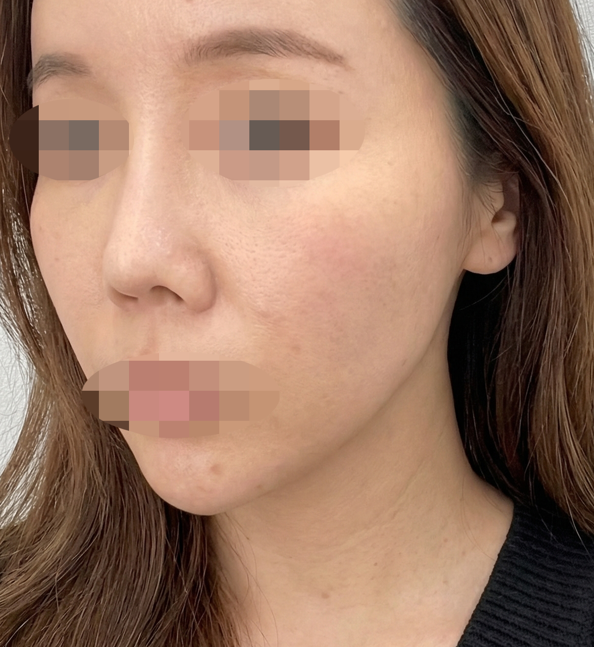 수술후기이미지