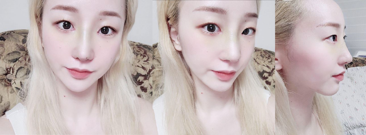 코수술 자세한 후기