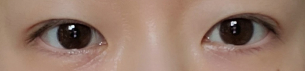 수술후기이미지