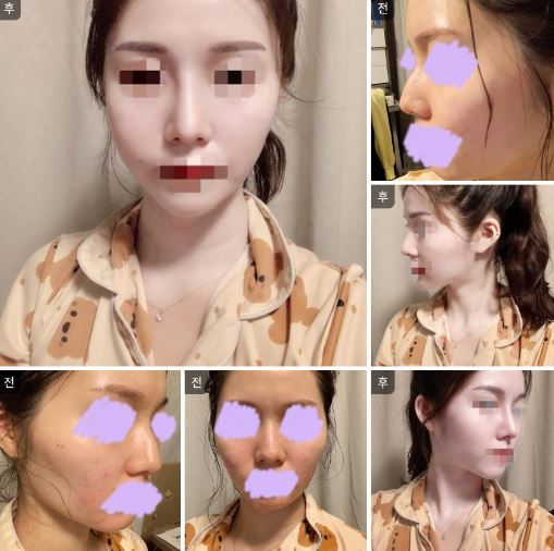 수술후기이미지