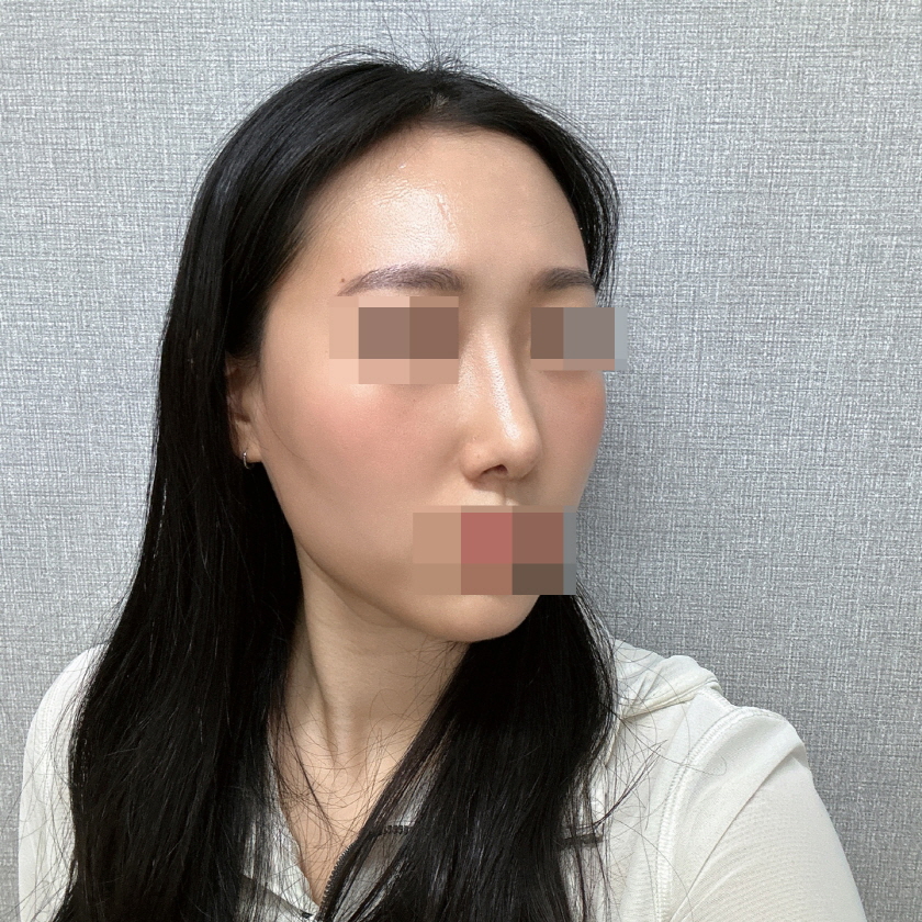 수술후기이미지