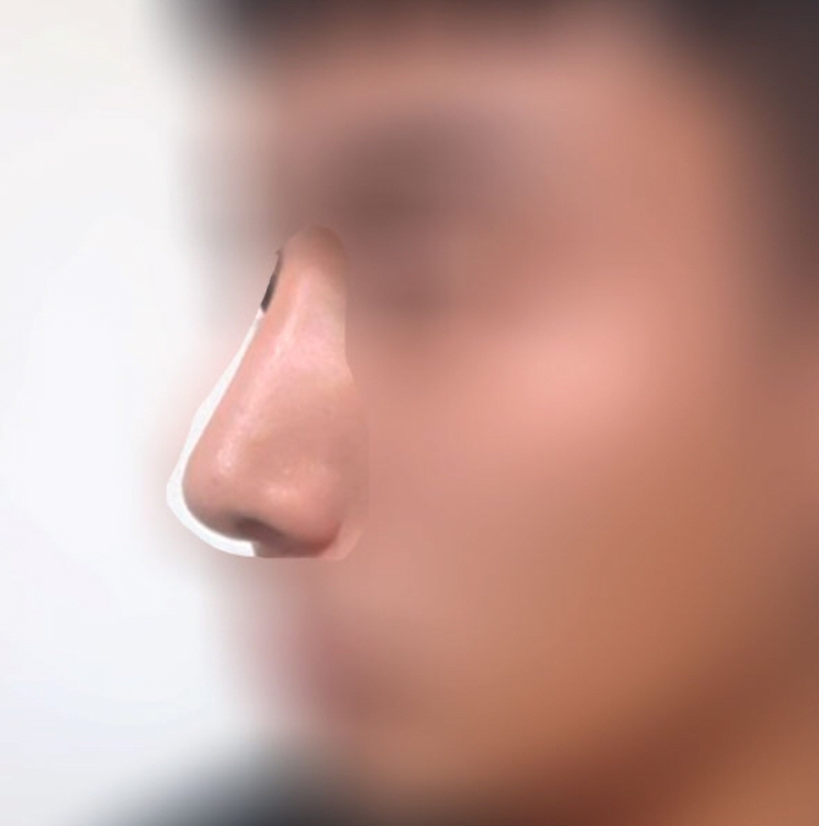 수술후기이미지