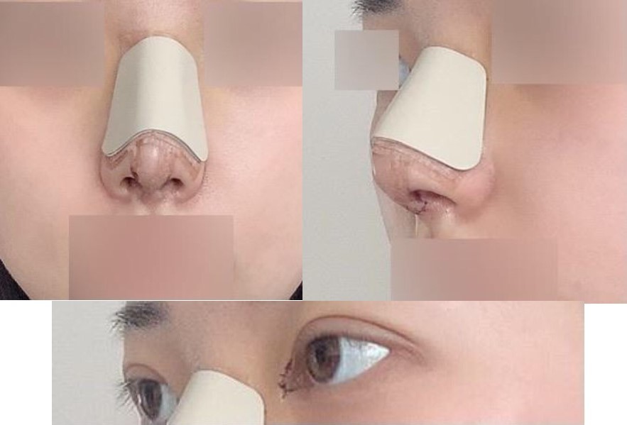 수술후기이미지