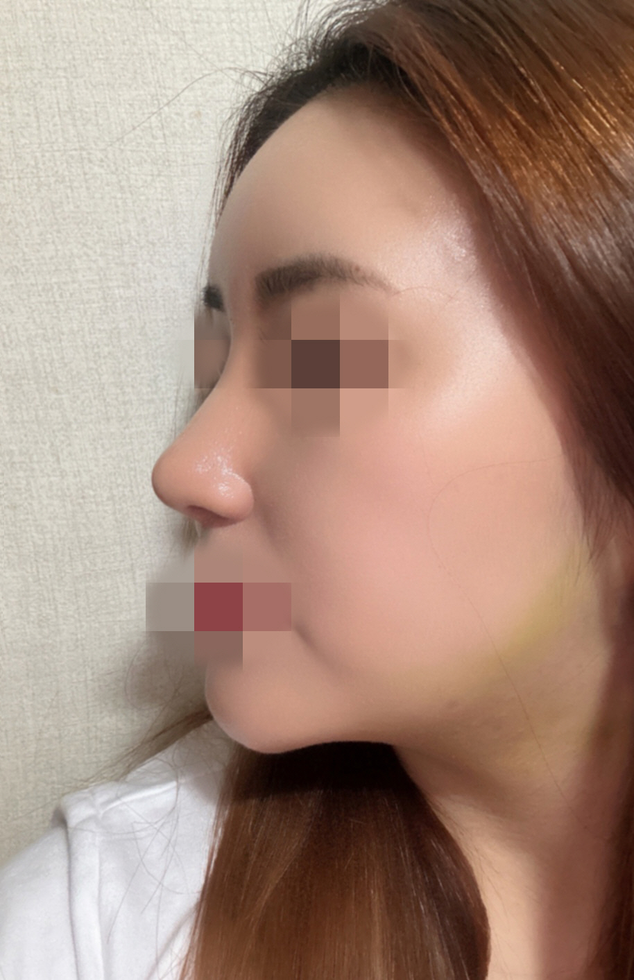 수술후기이미지