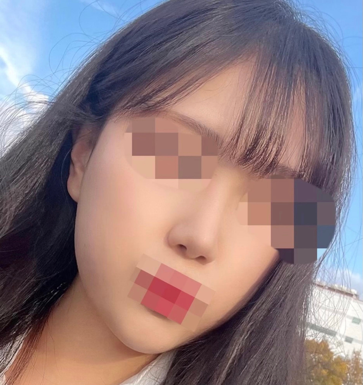 수술후기이미지