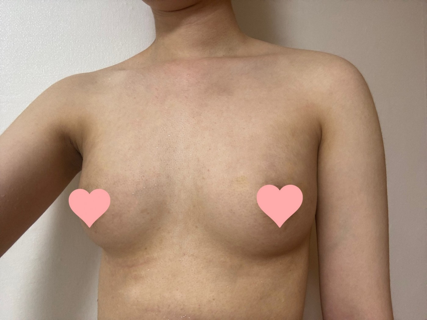 수술후기이미지