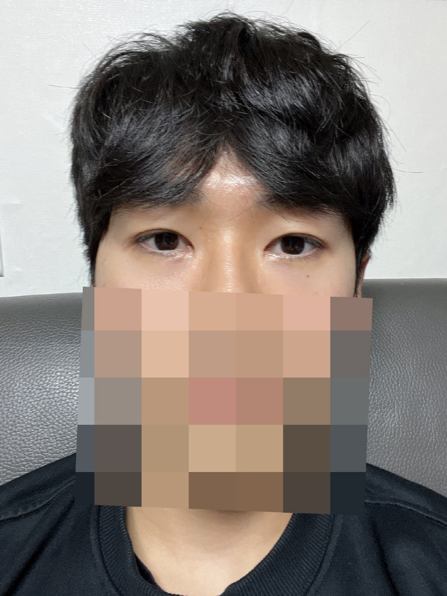 수술후기이미지