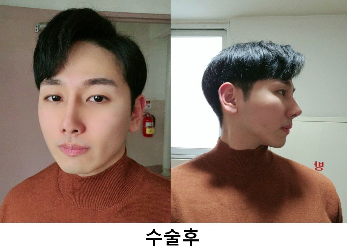 수술후기이미지