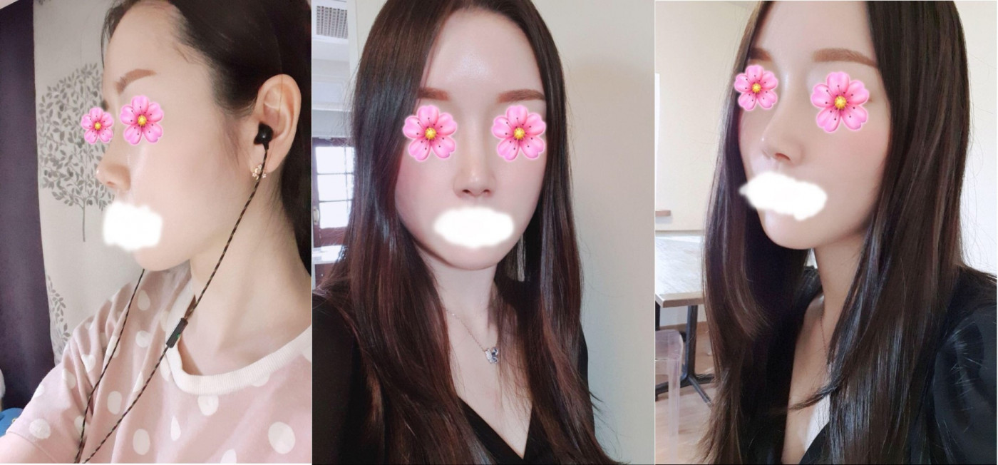 수술후기이미지