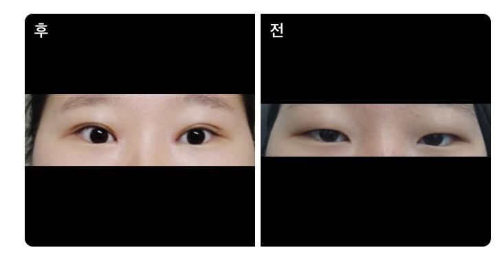 수술후기이미지