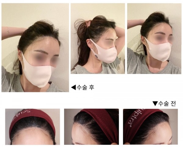 헤어라인 비절개 모발이식했어요