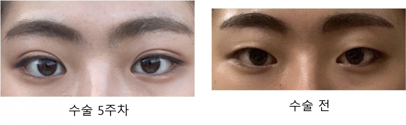 쌍꺼풀 5주차!