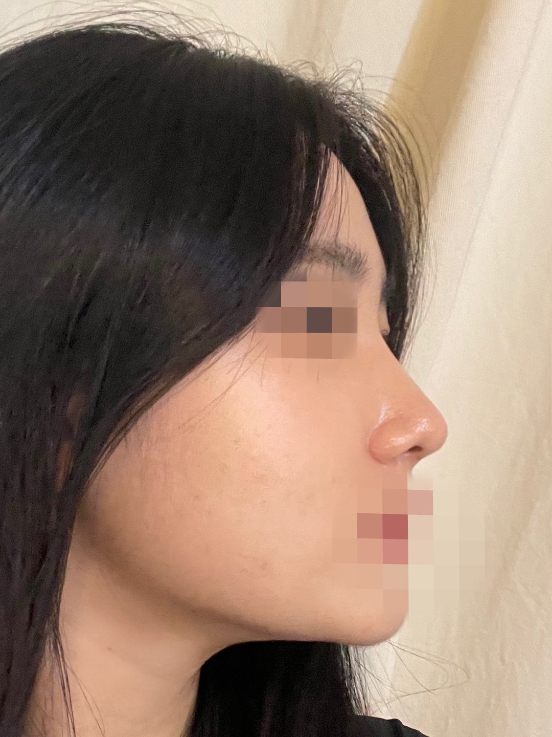 수술후기이미지