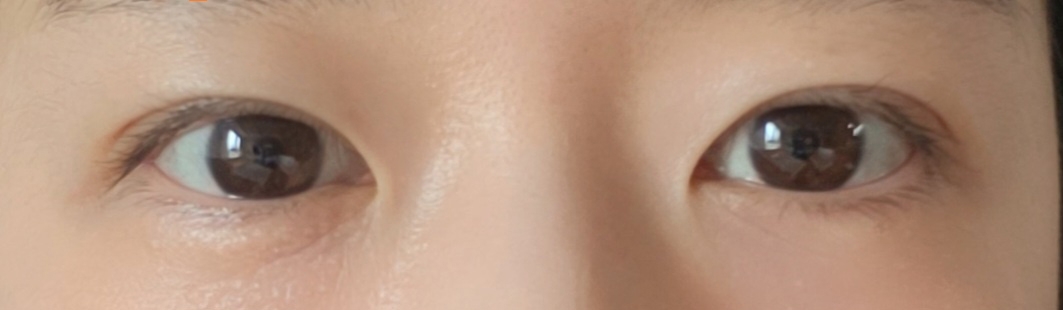 수술후기이미지