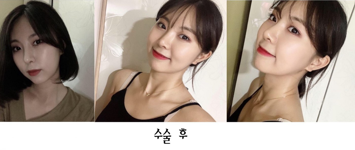 수술후기이미지