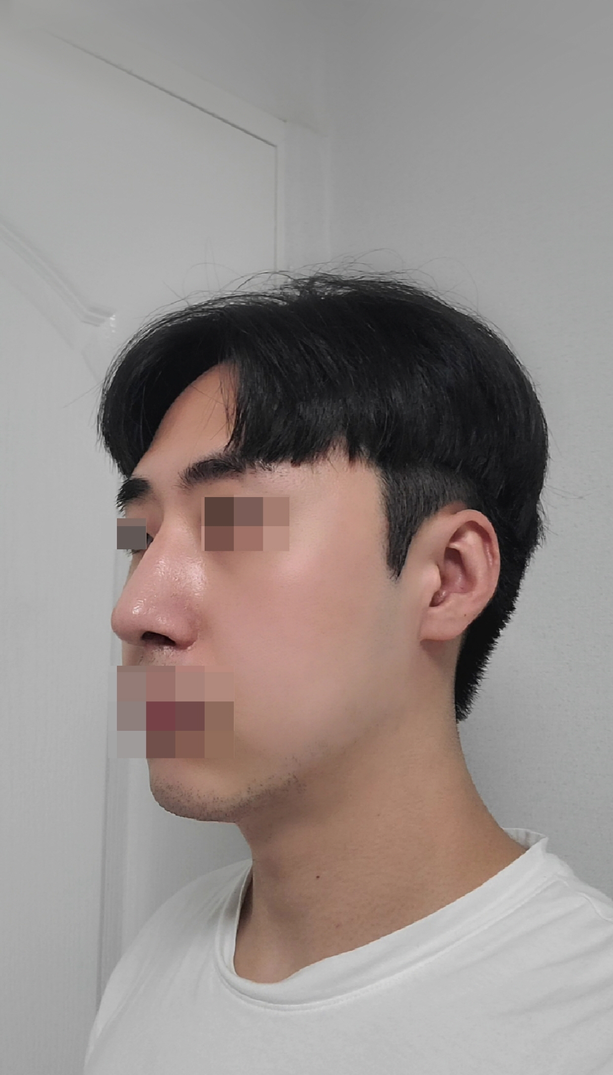 수술후기이미지