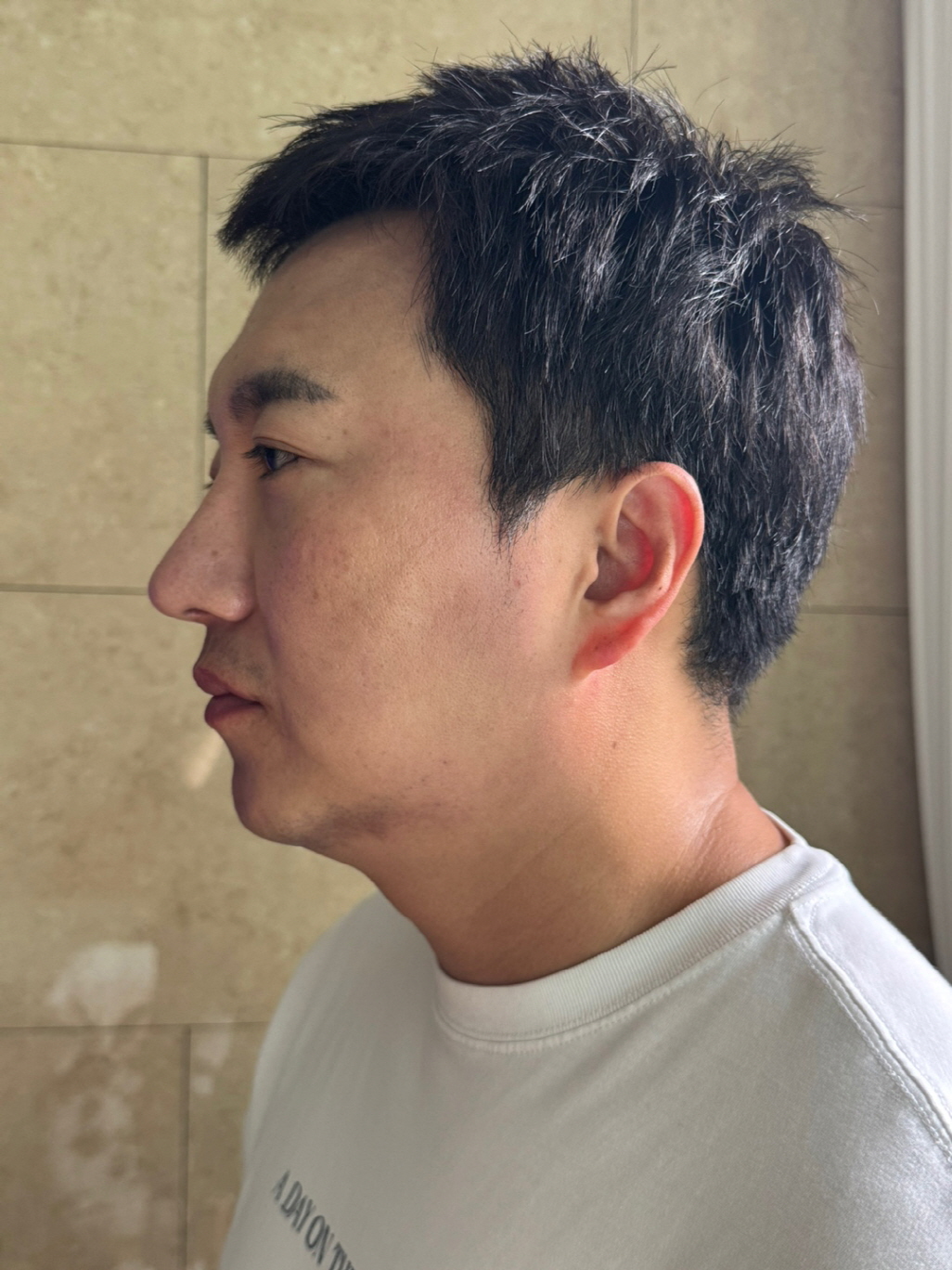 수술후기이미지